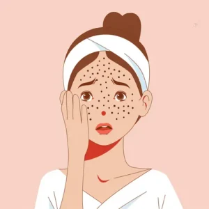 Acne Explained: Why Breakouts Occur and How to Manage Them